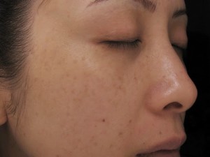 Tư vấn cách chữa nám da mặt sau sinh hiệu quả